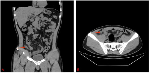 intra abdominal klebsiella abscess