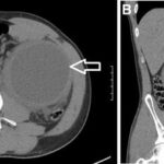 intra abdominal peptostreptococcus abscess