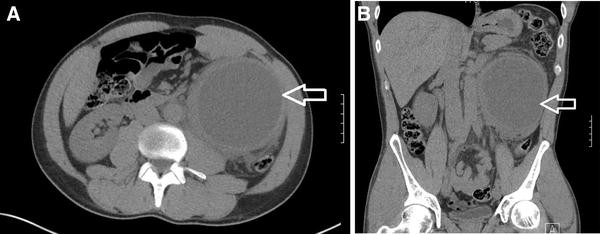 intra abdominal peptostreptococcus abscess