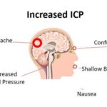 intracranial hypertension