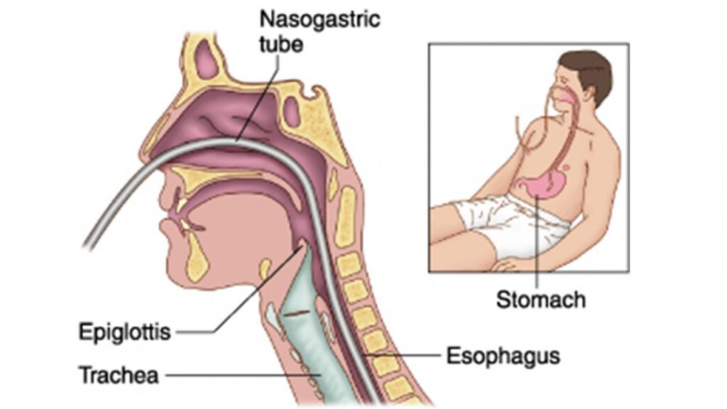 intubation of gastrointestinal tract