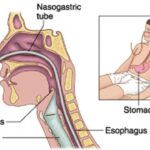 intubation of gastrointestinal tract