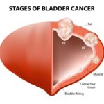 invasive bladder cancer