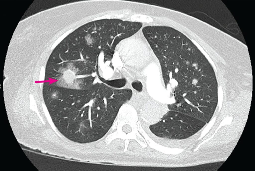 invasive pulmonary aspergillosis