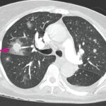 invasive pulmonary aspergillosis