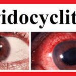 iridocyclitis