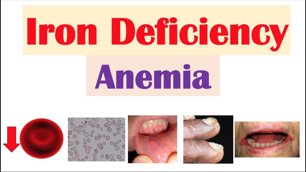 iron deficiency anemia