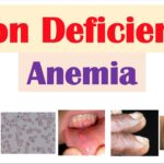 iron deficiency anemia