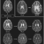 juvenile metachromatic leukodystrophy