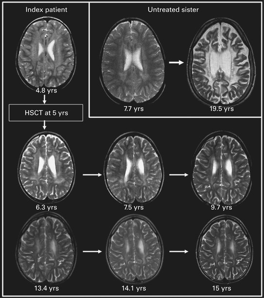 juvenile metachromatic leukodystrophy