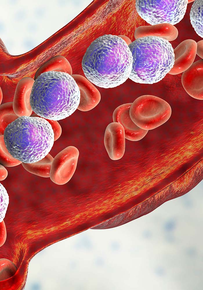 juvenile myelomonocytic leukemia