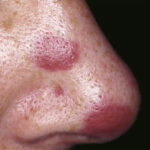 kaposi's sarcoma skin lesion