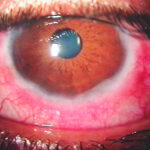 keratoconjunctivitis