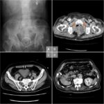 klebsiella cystitis