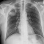 klebsiella lung abscess