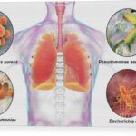 klebsiella nosocomial pneumonia