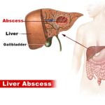 liver abscess