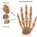 osteoarthritis
