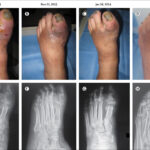 osteomyelitis