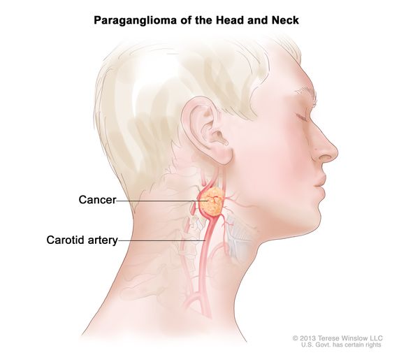 paraganglioma