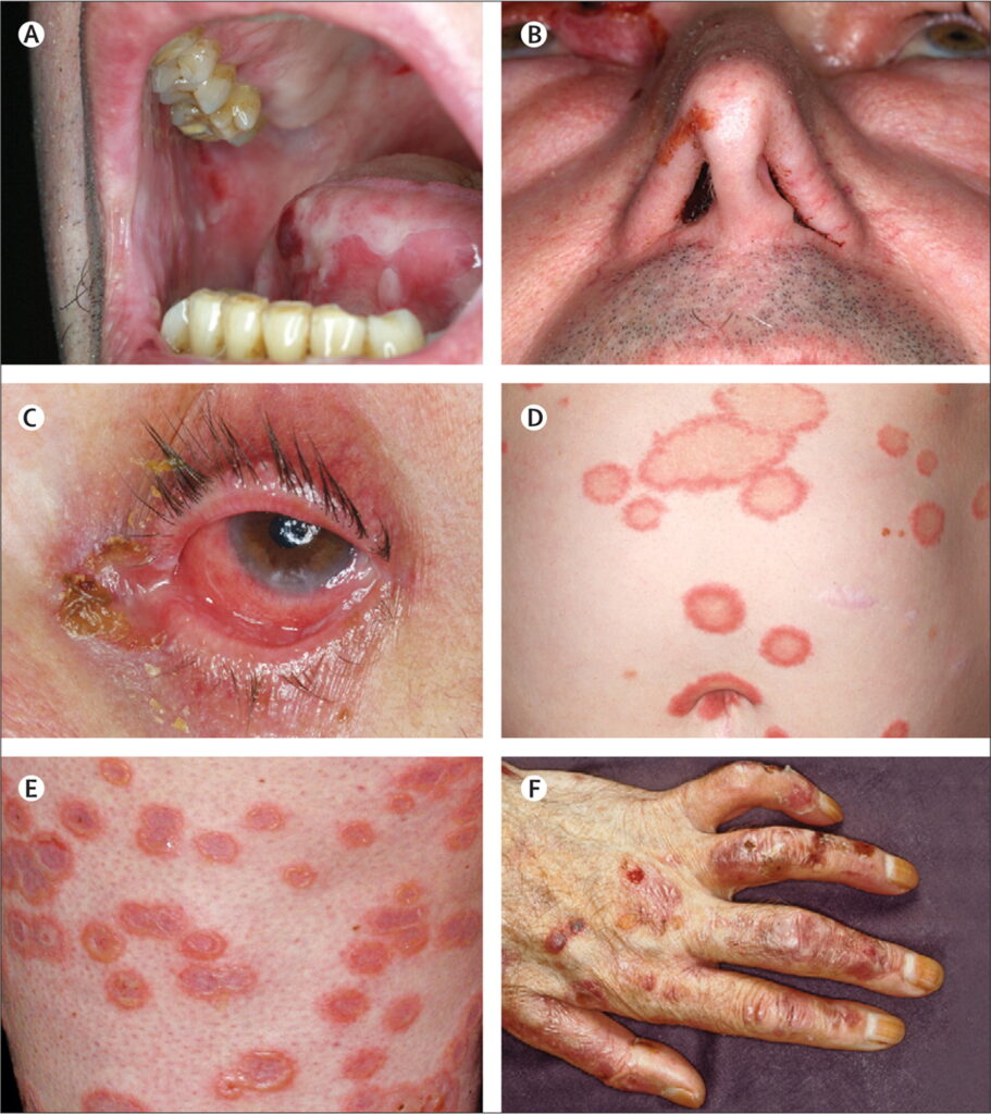 pemphigoid