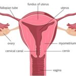 peptococcus pelvic cellulitis