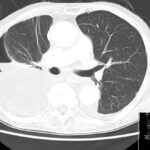 pleural empyema