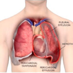 pleural malignant effusion