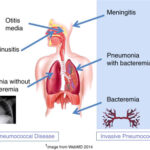 pneumococcal infection