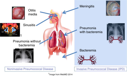 pneumococcal infection