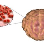 pneumococcal meningitis
