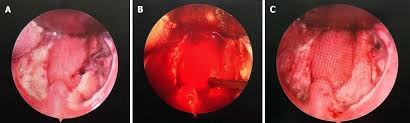 postsurgical hemorrhage