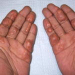 primary dysbetalipoproteinemia
