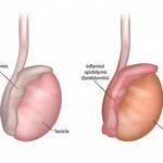 primary hypogonadism due to orchitis