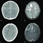 proteus meningitis