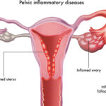 proteus pelvic inflammatory disease