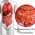 proteus peritonitis