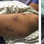 pruritus in hemodialysis-dependent chronic kidney disease