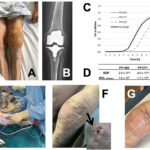pseudomonas aeruginosa joint infection