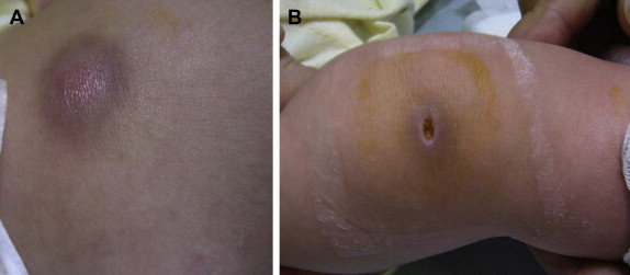 pseudomonas aeruginosa septicemia