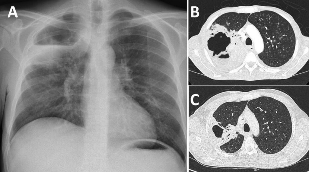 pulmonary actinomycosis