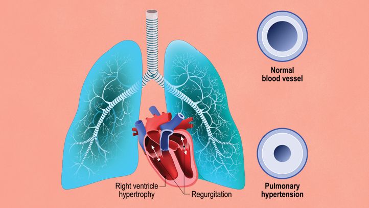 pulmonary arterial hypertension