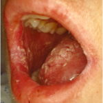refractory oropharyngeal candidiasis