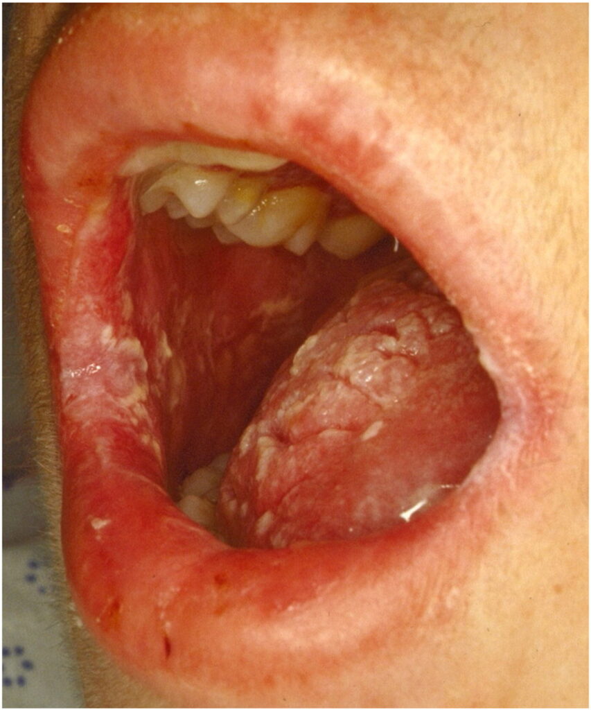 refractory oropharyngeal candidiasis