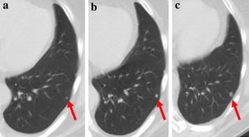 refractory osteosarcoma
