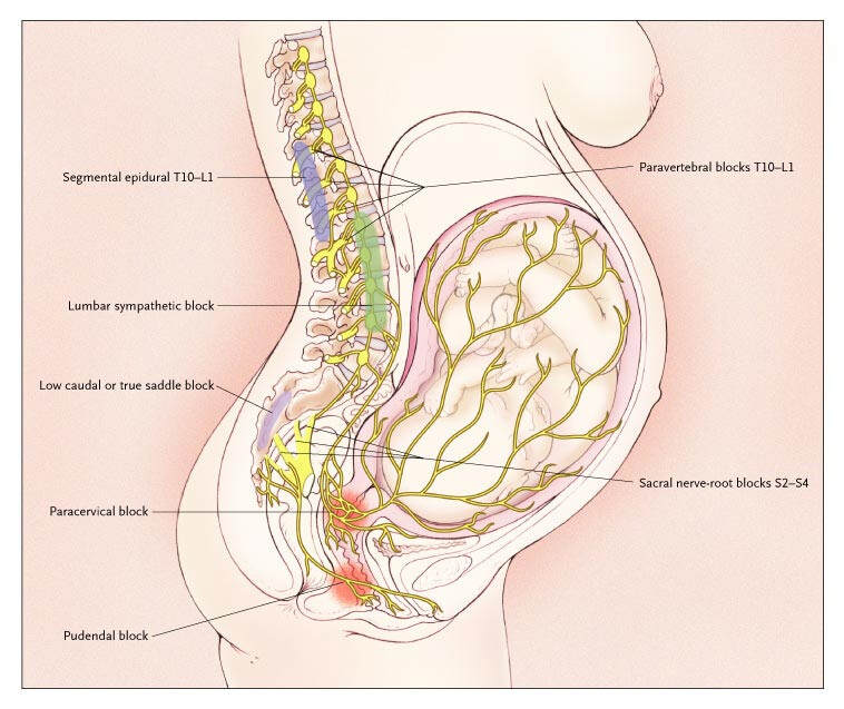 regional anesthesia for labor pain