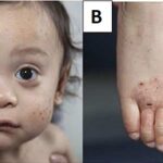 Wiskott-Aldrich Syndrome