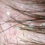 seborrheic dermatitis