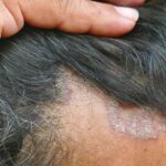 seborrheic dermatitis of scalp