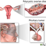 secondary amenorrhea